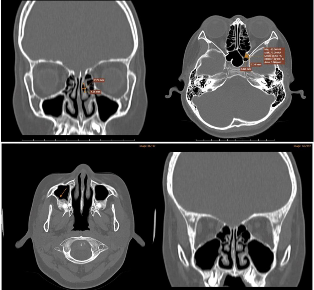 Biến chứng nguy hiểm của bệnh Zona do tự ý dùng Corticoid kéo dài - ảnh 2