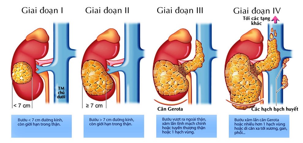 Hút thuốc lá làm tăng 50% nguy cơ mắc ung thư thận - ảnh 1