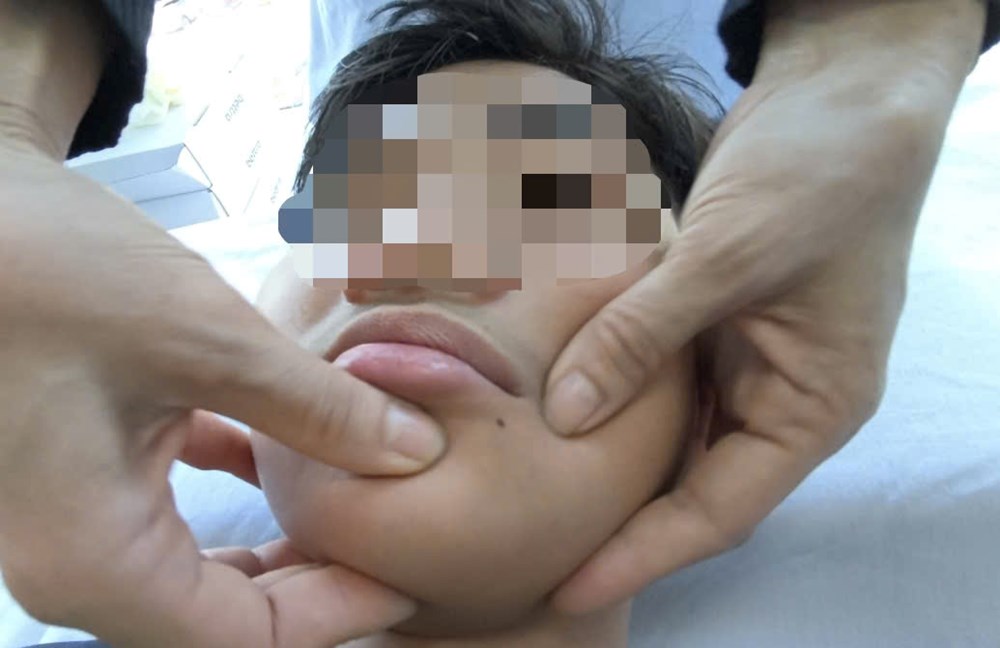 Liệt dây thần kinh số VII do nhiễm lạnh dễ lẫn với dấu hiệu đột quỵ - ảnh 3