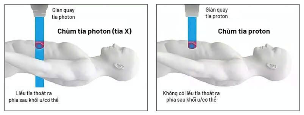 Ưu thế vượt trội của “siêu máy” điều trị ung thư Việt Nam vừa đặt mua của Mỹ - ảnh 2