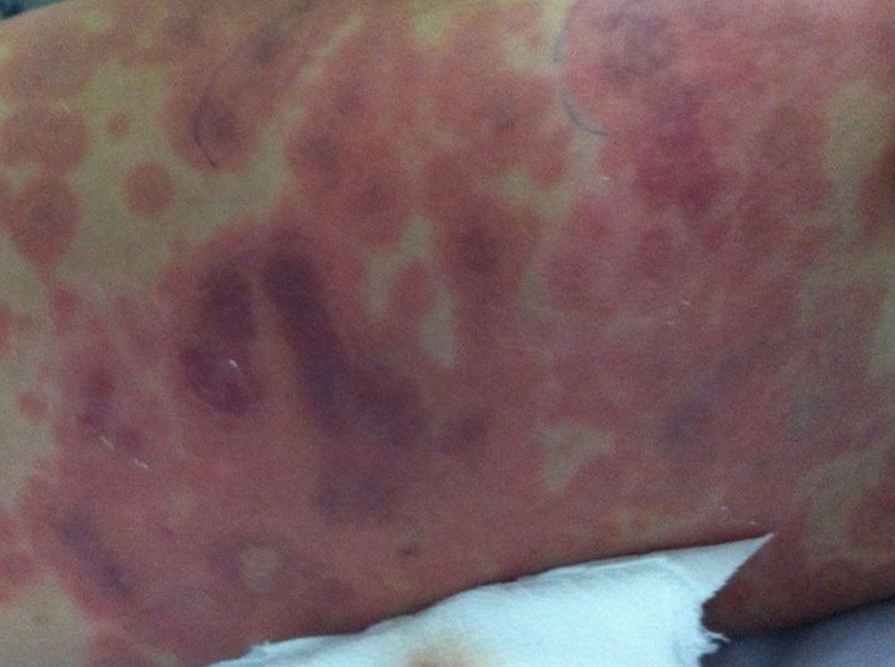 4 trường hợp tử vong vì viêm não mô cầu - ảnh 1