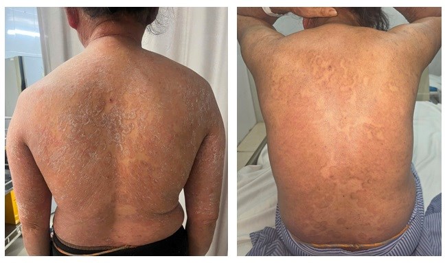 “Thảm họa” bôi thuốc trị bệnh nấm da không rõ nguồn gốc - ảnh 1