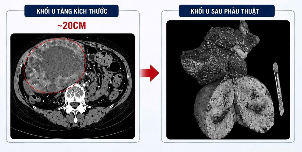 Tự chữa bệnh bằng thuốc nam, khối u gan tăng gấp 10 lần - ảnh 2