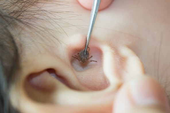 Trong nhà nuôi nhiều thú cưng, bọ chét ký sinh trên màng nhĩ bé gái 2 tuổi - ảnh 1