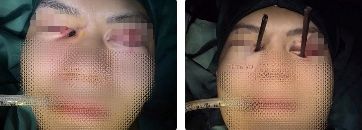 Cần làm gì khi bị vật sắc nhọn đâm xuyên cơ thể? - ảnh 3