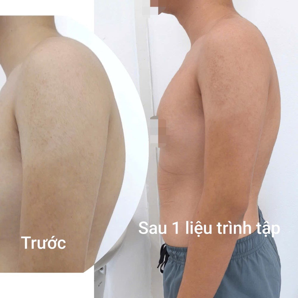 Điều trị gù lưng không cần phẫu thuật - ảnh 1