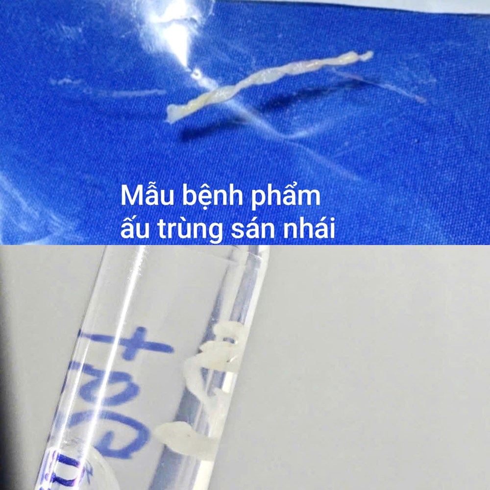 Lí do người đàn ông không ăn đồ sống vẫn bị sán - ảnh 2