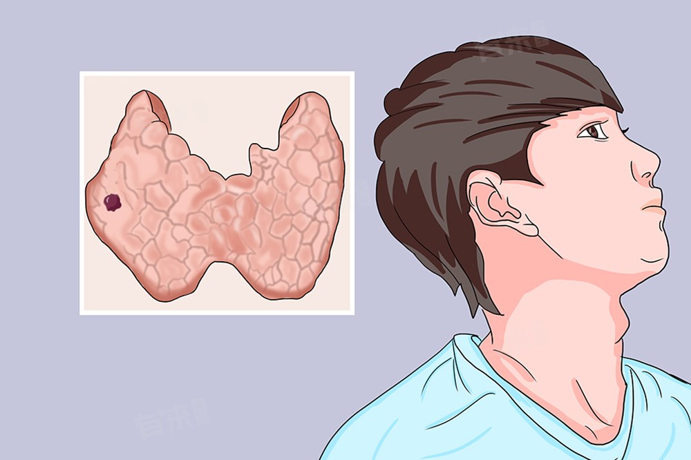 Nguyên nhân ung thư tuyến giáp ngày càng tăng nhưng giảm tỷ lệ tử vong - ảnh 1