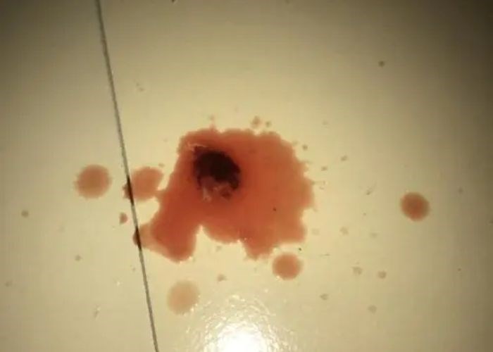 Nữ youtube qua đời khi mới 28 tuổi vì ung thư thận: Bệnh có thể chữa khỏi? Dấu hiệu sớm cảnh báo là gì? - ảnh 3