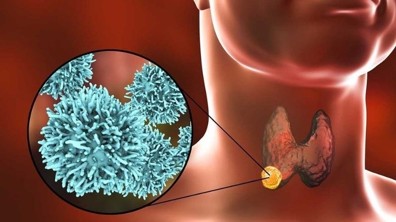 Nhiều người đi siêu âm phát hiện có nang giáp, bác sĩ chỉ ngay 5 dấu hiệu cảnh báo cần đi khám lại ngay lập tức - ảnh 1