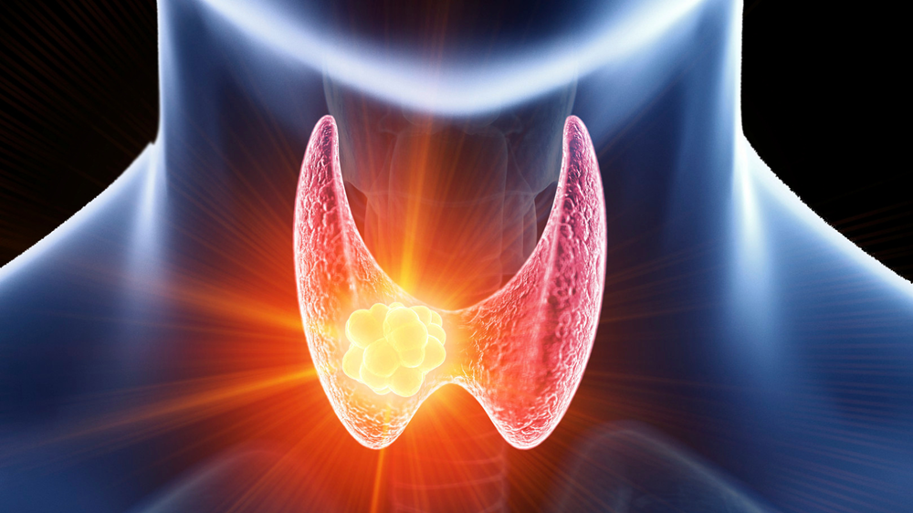 Nhiều người đi siêu âm phát hiện có nang giáp, bác sĩ chỉ ngay 5 dấu hiệu cảnh báo cần đi khám lại ngay lập tức - ảnh 2