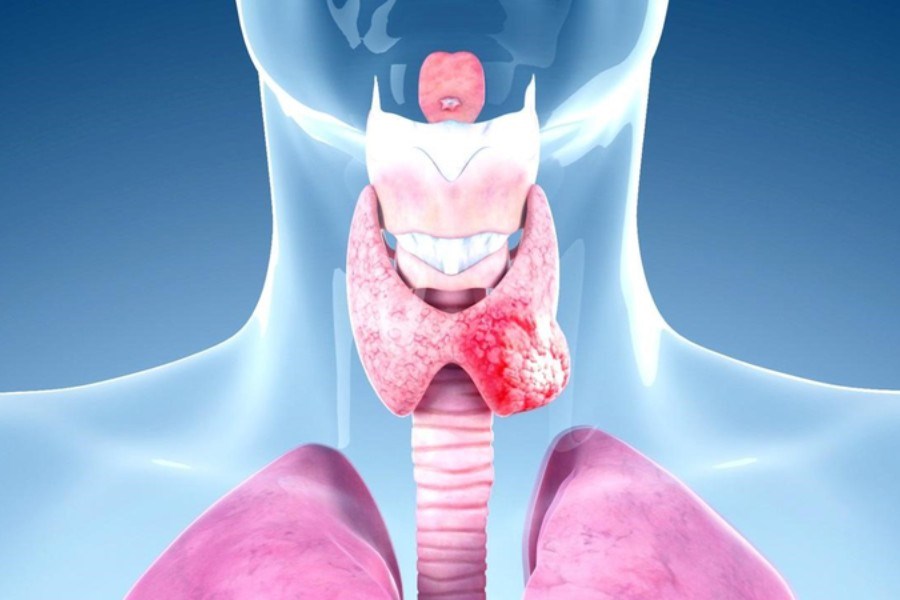 Nhiều người đi siêu âm phát hiện có nang giáp, bác sĩ chỉ ngay 5 dấu hiệu cảnh báo cần đi khám lại ngay lập tức - ảnh 3