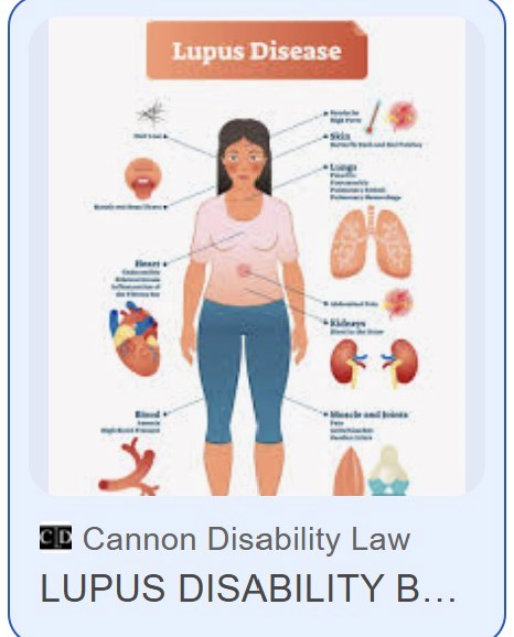 Bệnh nhân lupus ban đỏ nhận TIN VUI ngay đầu năm mới - ảnh 1