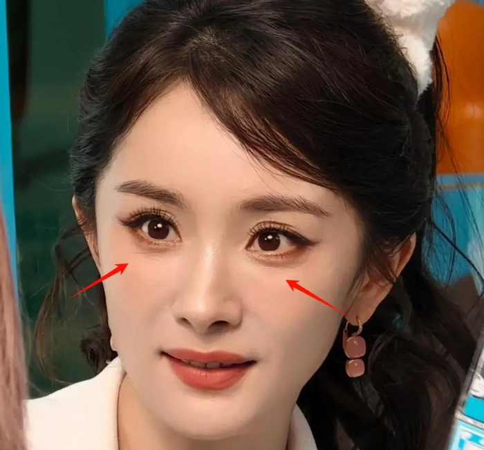 Bị nhăn mắt nhiều thì nên dùng Hifu hay Thermage? - ảnh 1