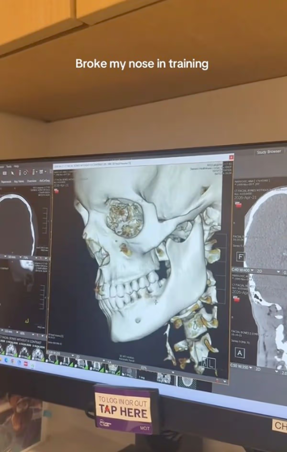 Nữ cầu thủ xinh đẹp nhất thế giới bị chị gái húc gãy mũi - ảnh 4