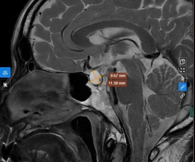 Hình ảnh khối u được phát hiện trên kết quả chụp MRI tuyến yên - (Ảnh:BVCC).