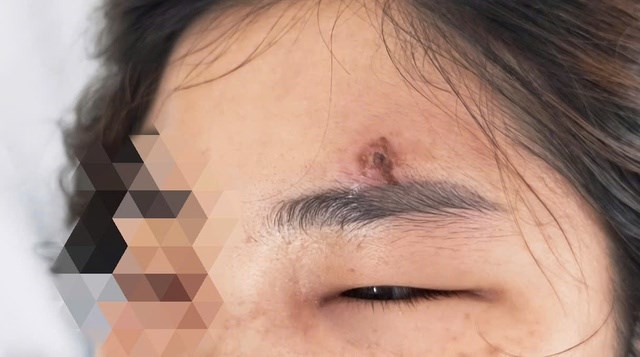 Thói quen nặn mụn bằng tay khiến chị D.T.L phải nhập viện trong tình trạng viêm mô bào nghiêm trọng, nguy cơ nhiễm trùng huyết nếu không được xử lý kịp thời - (Ảnh: BVCC).