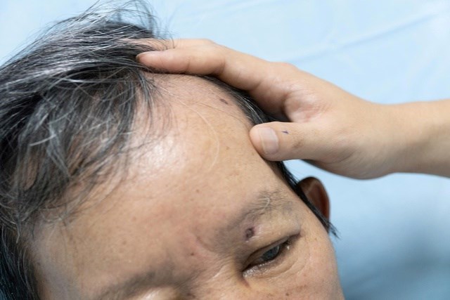 Ông D. bị hơn 30 vết ong đốt.