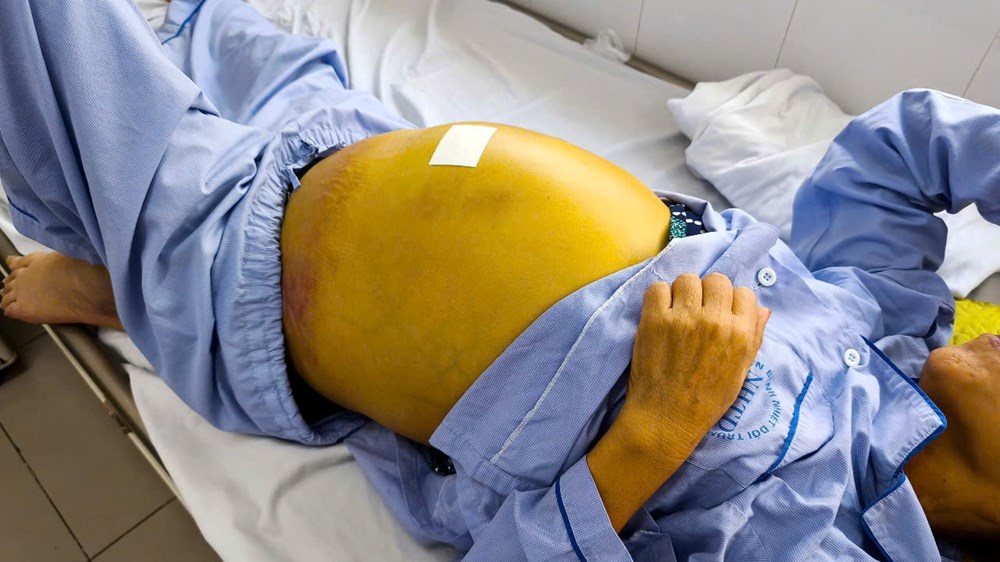Bệnh nhân được chẩn đoán xơ gan mất bù, bị viêm gan B mạn tính và cổ chướng căng (Ảnh: BVCC).