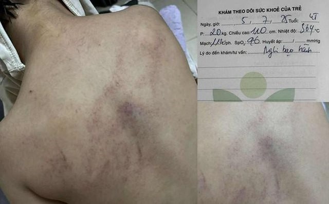 Hình ảnh vùng lưng bé gái 4 tuổi bị bầm tím.