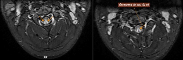 Hình ảnh MRI của bệnh nhân phát hiện tổn thương sau tủy cổ (Ảnh: BSCC).