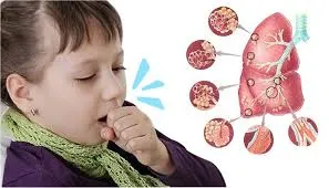 TP.HCM ghi nhận một trường hợp mắc bệnh ho gà - ảnh 1
