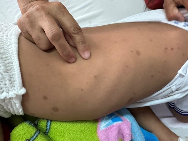 Nhiều vết ong đốt trên cơ thể của bệnh nhi.