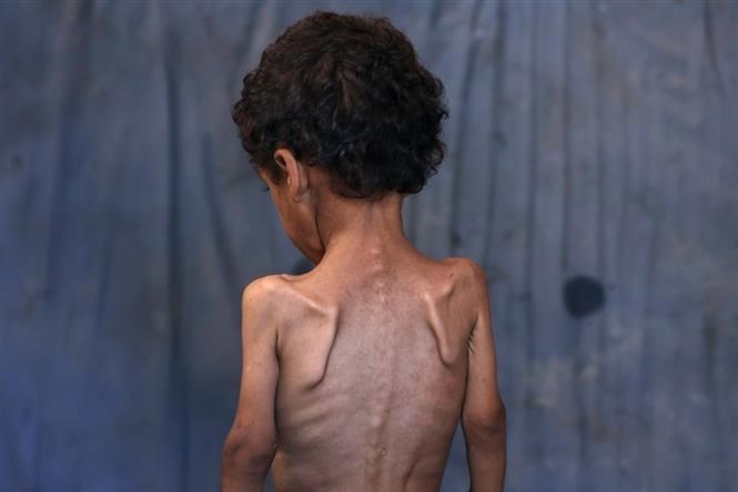 Em nhỏ Palestine 2 tuổi bị suy dinh dưỡng tại trại tị nạn Al-Shati ở phía Tây Dải Gaza, ngày 23.7.2025. Ảnh: Getty Images/TTXVN