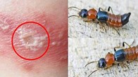 5 bước xử lý đúng cách khi tiếp xúc với kiến 3 khoang