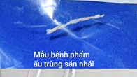 Lí do người đàn ông không ăn đồ sống vẫn bị sán