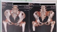 TP.HCM: Phát hiện hội chứng “người hóa đá” thể cực hiếm ở bệnh nhi 12 tuổi 