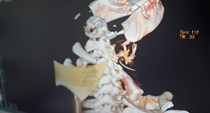 Nam thanh niên phải phẫu thuật chỉ vì chủ quan với hóc xương cá