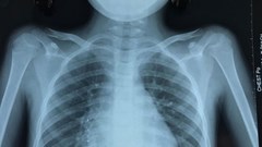 Cứu sống bệnh nhân nhi suýt vỡ động mạch phổi do bệnh hiếm