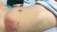 Hoại tử da vì bố mẹ dán cao chữa nhọt cho con