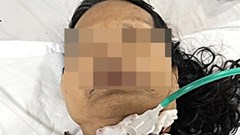 Quảng Nam: Cứu sống bệnh nhân bị đứt khí quản do ngã vào dao mổ gà