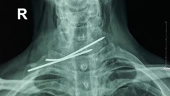 Cần Thơ: Phẫu thuật thành công bệnh nhân bị đinh đâm xuyên thực quản, khí quản