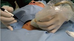Nhẹ nhàng loại bỏ u tuyến giáp, không cần mổ