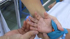 Không để dịch tay chân miệng lây lan trong cộng đồng