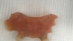 Gắp thành công cung răng giả trong thực quản