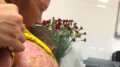 Mụn mủ, da vẩy hiếm gặp ở bé người dân tộc Nùng