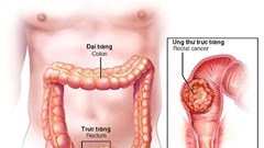 Một gia đình 7 - 8 người ung thư đại tràng