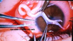 Mất cảm giác giác mạc có thể dẫn đến mù loà