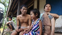 Cảm động chuyện tình “rổ rá” giữa cô nàng “chân voi” và anh chàng mù