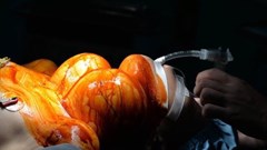 Khối u nặng 4kg vì chủ quan không thăm khám