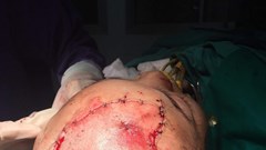 Nữ công nhân bị bóc da đầu vì máy ép tôn cuốn vào tóc