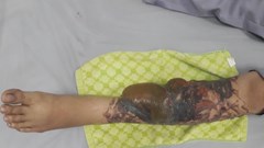 Bỏng cả cẳng chân vì đi xoá vết xăm