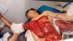 Phú Thọ: Hai tuần, 4 nạn nhân nguy kịch vì tai nạn máy bóc gỗ