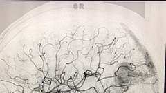 Đau đầu dữ dội có thể là triệu chứng của dị dạng mạch máu não
