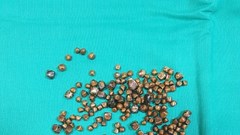 Gắp gần 400 viên sỏi lấp đầy túi mật cho bệnh nhân nữ