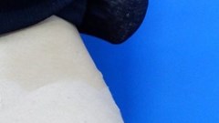 Cô gái bị biến dạng vòng 3 chỉ vì làm đẹp bằng chất không rõ nguồn gốc